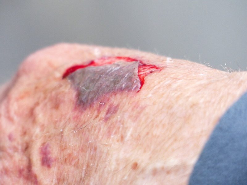 news-3d-skin-printer-wound