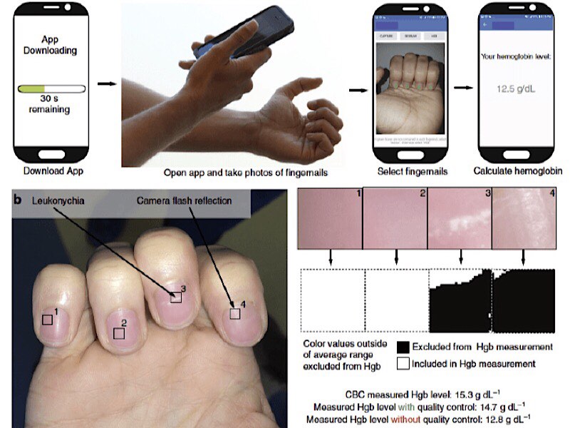 news-anemia-fingernails-diagram