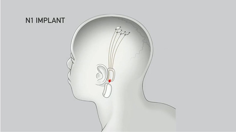 Bci Neuralink Implant