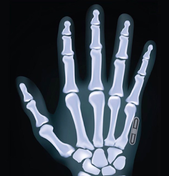 Microchip Implants Contactless Payments Hand