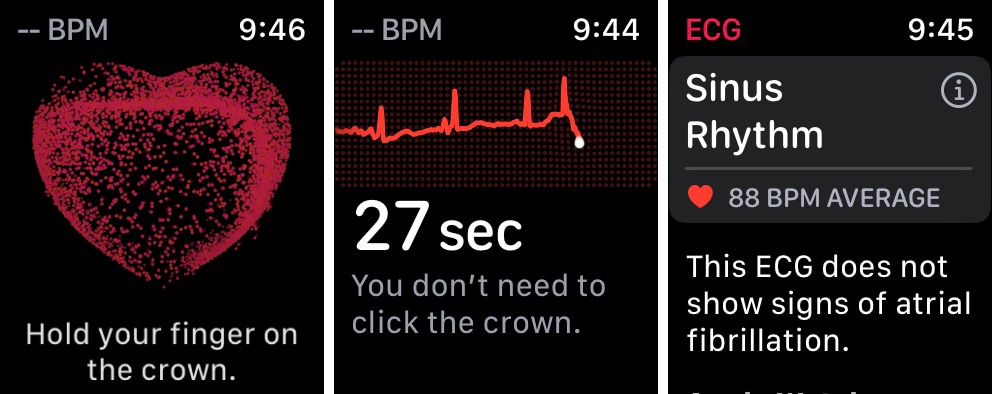 ECG app on Apple Watch