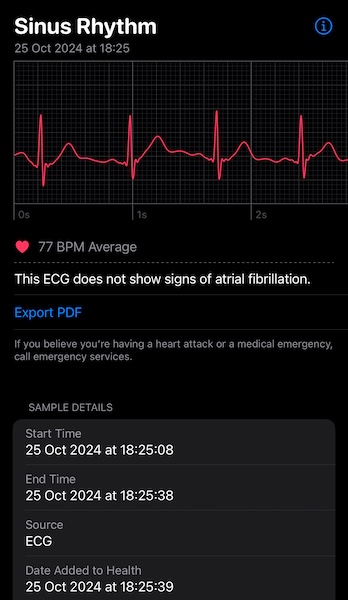 Apple Watch Ecg Graph