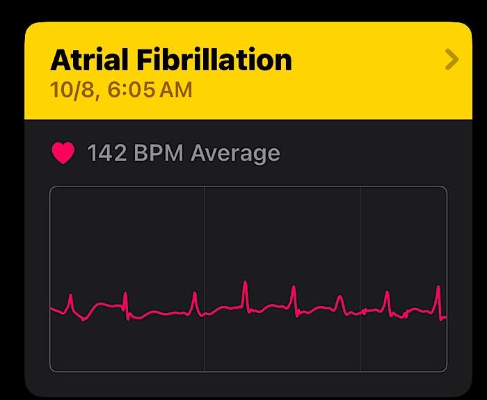 Apple Watch Saved Lives Afib Result